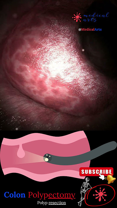Coloscopy | Colon Polyp Resection | Polypectomy