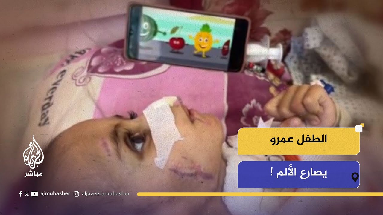 الطفل عمرو الهمص .. جريح يصارع الألم !