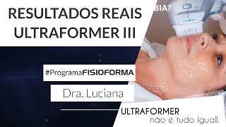 Ultraformer III Antes e Depois - Dra. Luciana Sensini