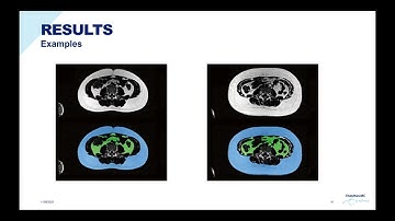 Automated Deep Learning-Based Segmentation of Abdominal Adipose Tissue on Dixon MRI in Adolescents