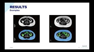 Automated Deep Learning-Based Segmentation of Abdominal Adipose Tissue on Dixon MRI in Adolescents