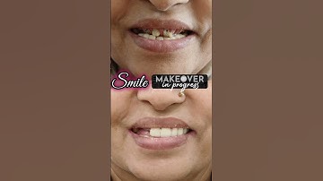 Smile Makeover in 7 days: Dr Srishti Bhatia #smile #smilemakeover