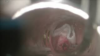 Multilobulated VC angiomatous polyp Transoral laser Surgery under GA