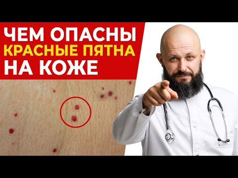 Появляются красные родинки — что это такое и как их убрать?