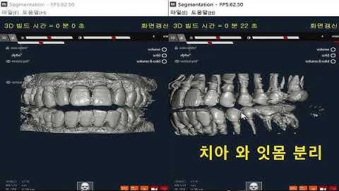 Semi Auto Tooth Segmentation Of Image Processing Base( from seed ct )