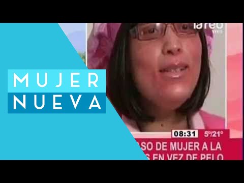 Vídeo: En Lugar De Cabello, La Mujer Comenzó A Crecer Uñas - Vista Alternativa