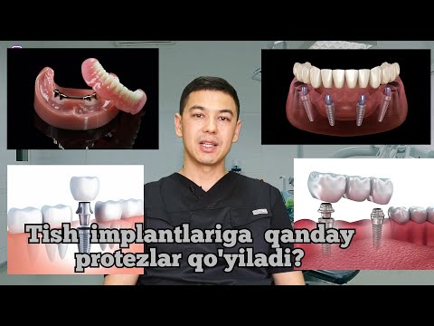 Video: Tish Implantlari: Ular Uy Hayvonlari Uchun Foydalimi?