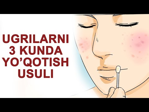 Video: O'smirlarda homiladorlikdan saqlanishning 3 usuli