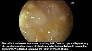 ESD of a gastric hamartomatous polyp in a 3-year-old child.