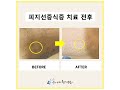피지선증식증,피지선비대증,피지선확장증 압출 치료