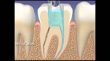 EndoVac Irrigation Technique
