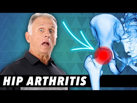 What Grade 4 Osteoarthritis Hip