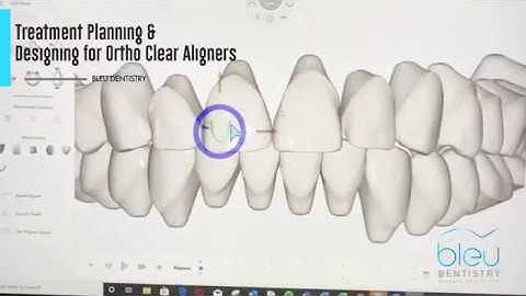 [Bleu Dentistry] Treatment planning & Designing for Ortho Clear Aligners