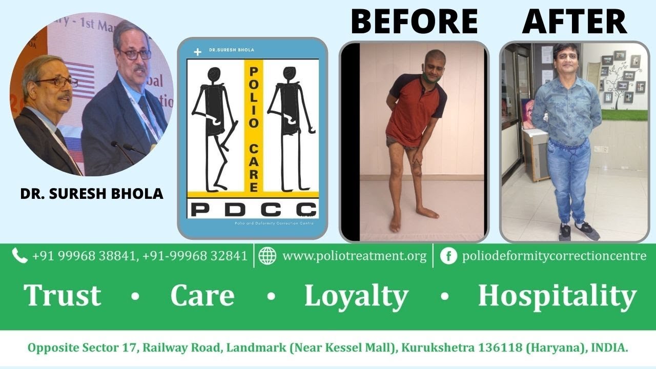 47 साल की उमर में पोलीयो / post पोलीयो syndrome के मरीज़ का  चलते हुए घुटने पर  से हाथ  रखना हट गया-