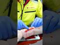 First Aid on a Deep Cut! 🚑🩸#ambulance #paramedic #emergency #firstaid #nurse #hospital