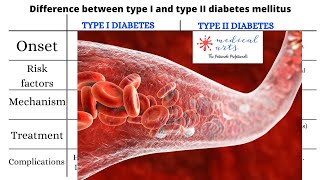 Difference Between Type1 And Type2 Diabetes Mellitus - High Quality Graphics