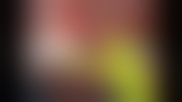 Acute Cholecystitis with Aberrant Artery at Calots operated by Da Vinci Xi Robotic Cholecystectomy