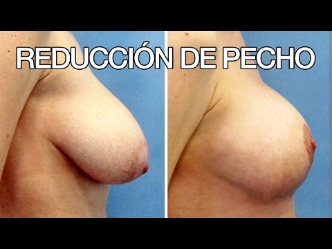 Video: La Modelo Mostró El Cuerpo Después De La Reducción De Senos Y Sorprendió A Los Fanáticos