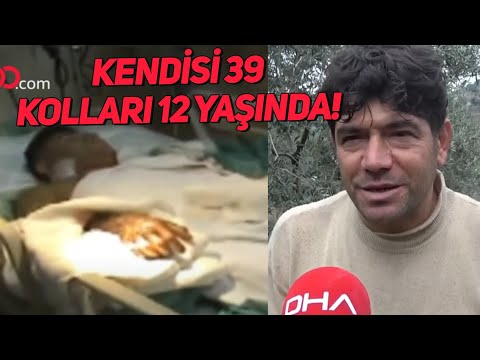 Türkiye'de ilk çift kol nakli yapılan hasta: Kendim 39, kollarım 12 yaşında