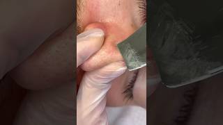 Men’s Nose Extractions