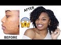 My Skincare Routine | How To Get Rid Of Acne, Dark Scars and Marks (Hyperpigmentation)