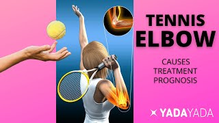 Tennis Elbow - Diagnosis and Treatment - AKA Lateral Epicondylitis - Elbow Pain