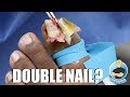 DOUBLE WHAMMY TOENAIL REMOVAL!!! ***PERMANENT TOENAIL REMOVAL***