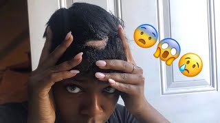 How I let anxiety/stress make me go BALD