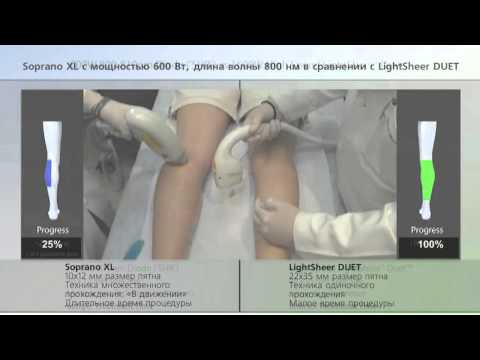 LightSheer DUET vs Soprano. Сравнение аппаратов. LightSheer DUET vs Soprano. Сравнение аппаратов.