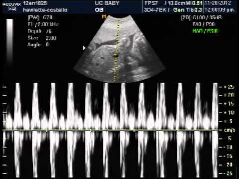Baby boys heart beat 25 weeks 3d ultrasound nov 20 2012 ...