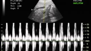 Baby boys heart beat 25 weeks 3d ultrasound nov 20 2012