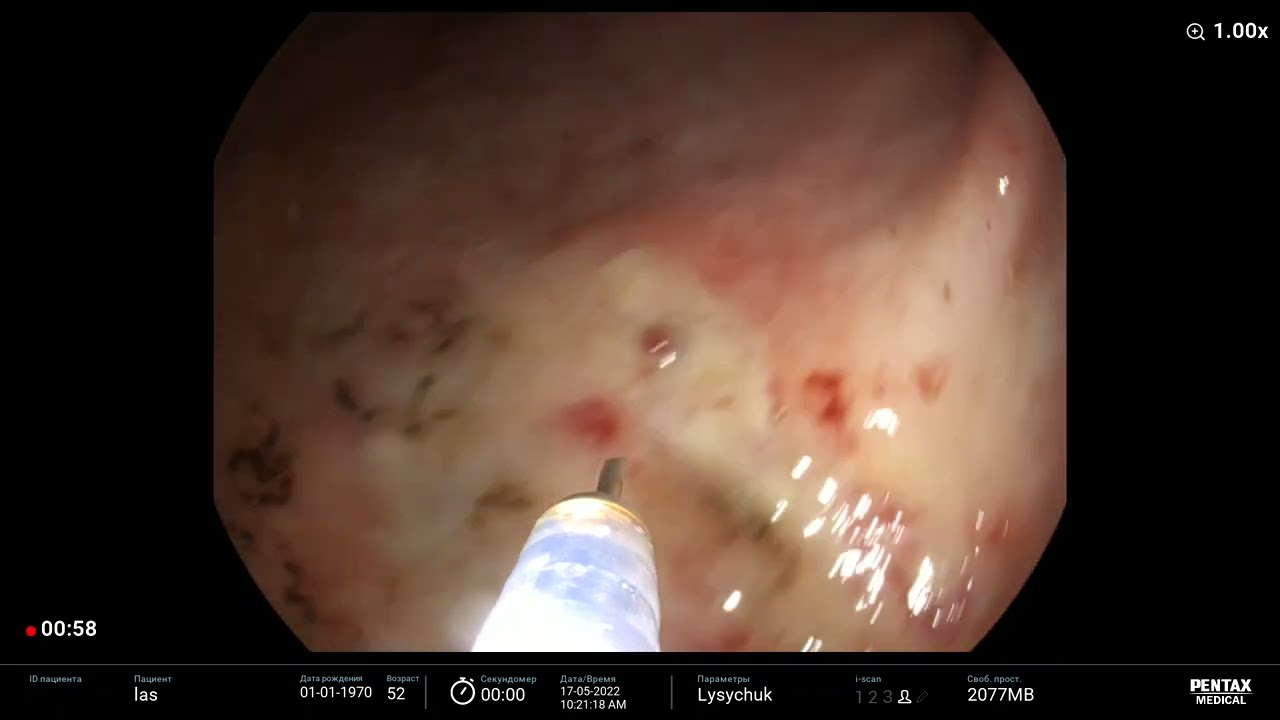 Dieulafoy ulcer/ Дьелафуа-подобный дефект, Forrest IIA, инъекционный гемостаз