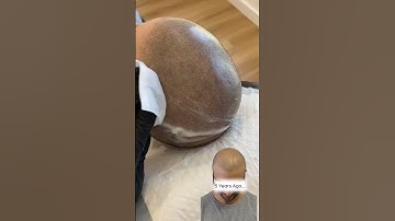 Unbelievable SMP Hair Transformation for Hair Loss #smp #scalpmicropigmentation