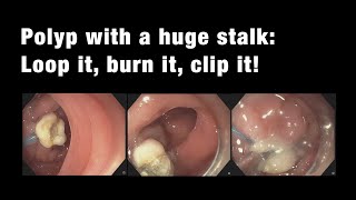 Polyp with a HUGE stalk: Loop it, Burn it, Clip it!