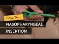 Tfc nasopharyngeal insertion