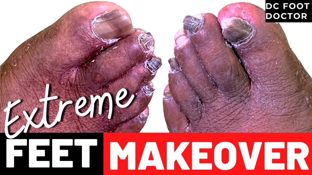 Extreme Feet Makeover Trimming Fungal Toenails (Part 1) YouTube