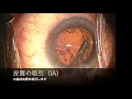 こうむら眼科の白内障手術（音声解説付き）