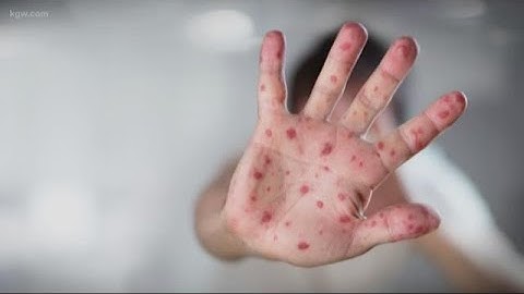 Doctors: Anti-vaxxer beliefs dangerous online