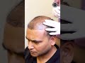 Prp treatment for hairloss  hair transplant clinic   dadu medical centre