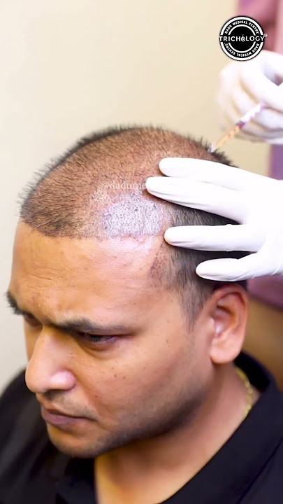 PRP Treatment for Hairloss | Hair Transplant Clinic  | Dadu Medical Centre