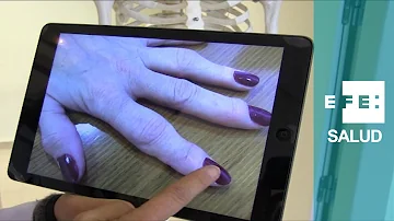 ¿Qué aspecto tiene un dedo con artritis?