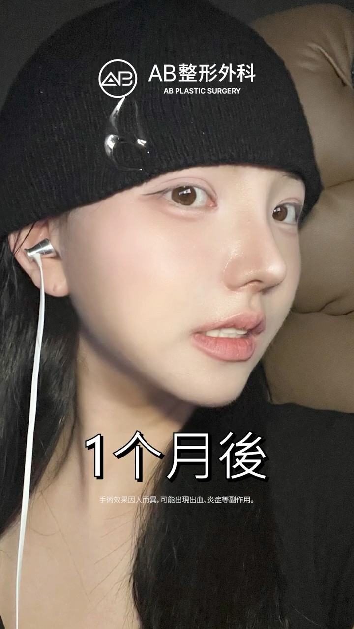 輪廓三項＋眼部整形＋鼻整形，整體氣質都變了✨ #Shorts