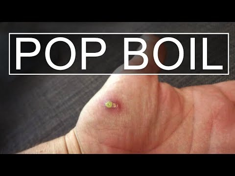 How to Lance / Pop - Boil Cyst