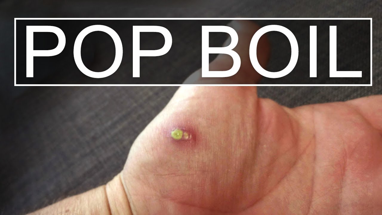 How To Lance / Pop - Boil Cyst - Youtube