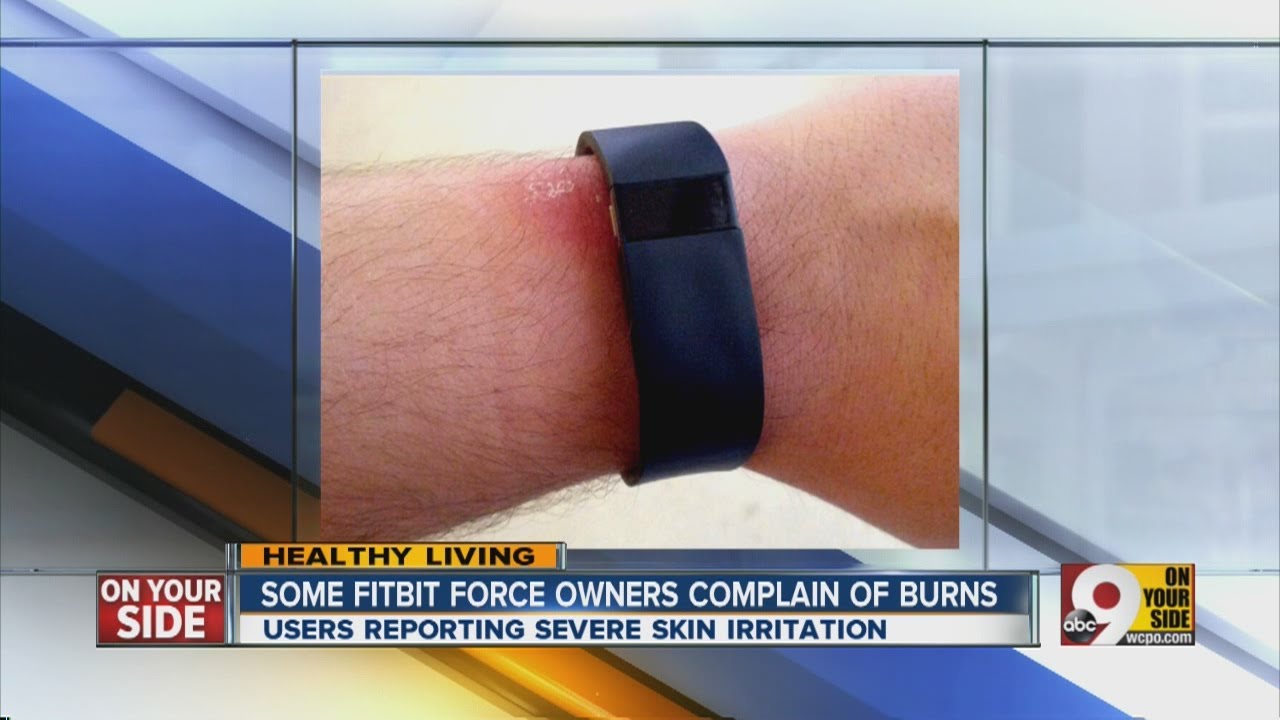 fitbit charge 3 burning skin