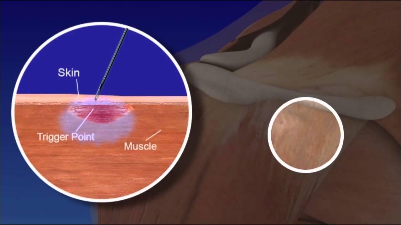 Trigger Point Injections