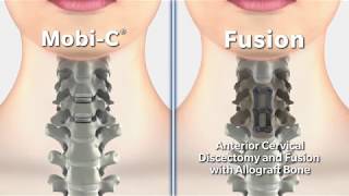 Cervical Disc Surgery  MobiC versus Fusion 2