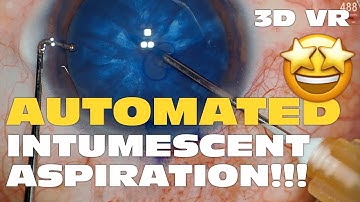 3D Phaco Clip #146 - Intumescent Cataract Automated Needle Aspiration (VR Headset Version)