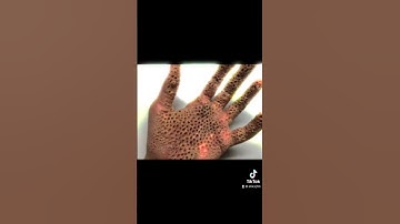 Thumbnail of These photos will trigger your Trypophobia (Fear of small holes):