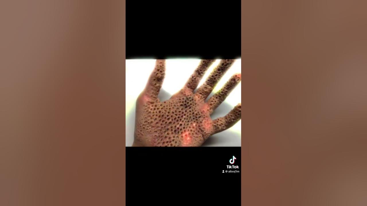 These photos will trigger your Trypophobia (Fear of small holes):